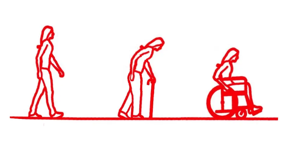 Changing mobility as arthritis progresses